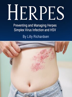 cover image of Herpes